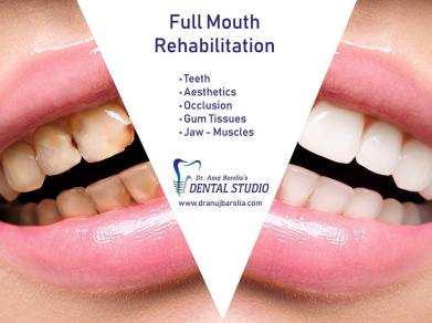 full mouth rehabiliation