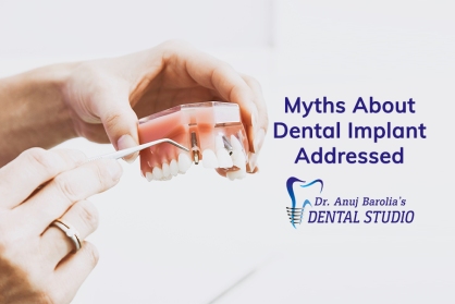 Myths-About-Dental-Implants-Address-Dr-Anuj-Barolia-Dental-Studio-in-Vadodara